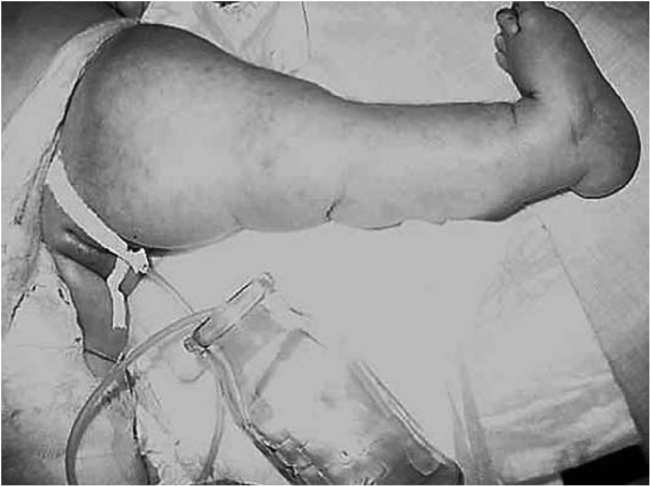 Ребенок Б., 1 мес. Анкилоз левого коленного сустава, вальгусная  деформация стопы