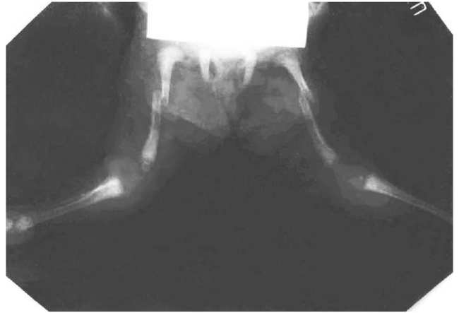 Ребенок Б., 1 мес. Рентгенограмма нижних конечностей: переломы обеих бедренных костей