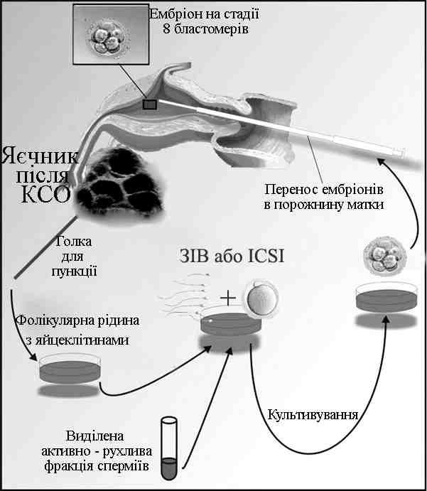 Технологія запліднення in vitro (схема)
