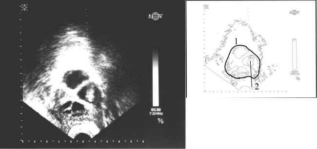 УЗ-сканограма яєчника в момент пункції фолікулів