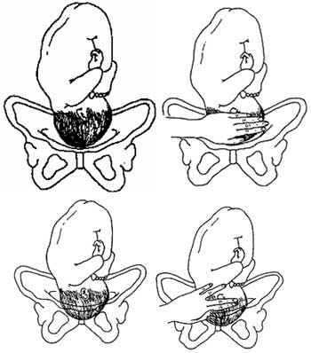 Визначення ступеню опускання голівки у порожнину тазу методом абдомінальної пальпації